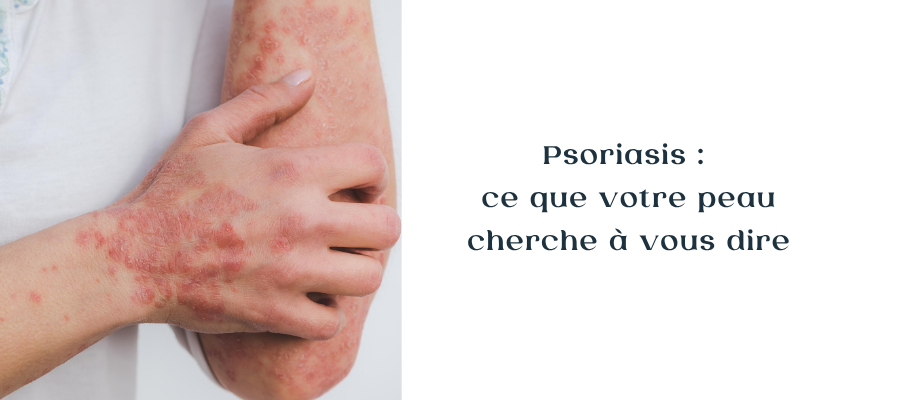 psoriasis